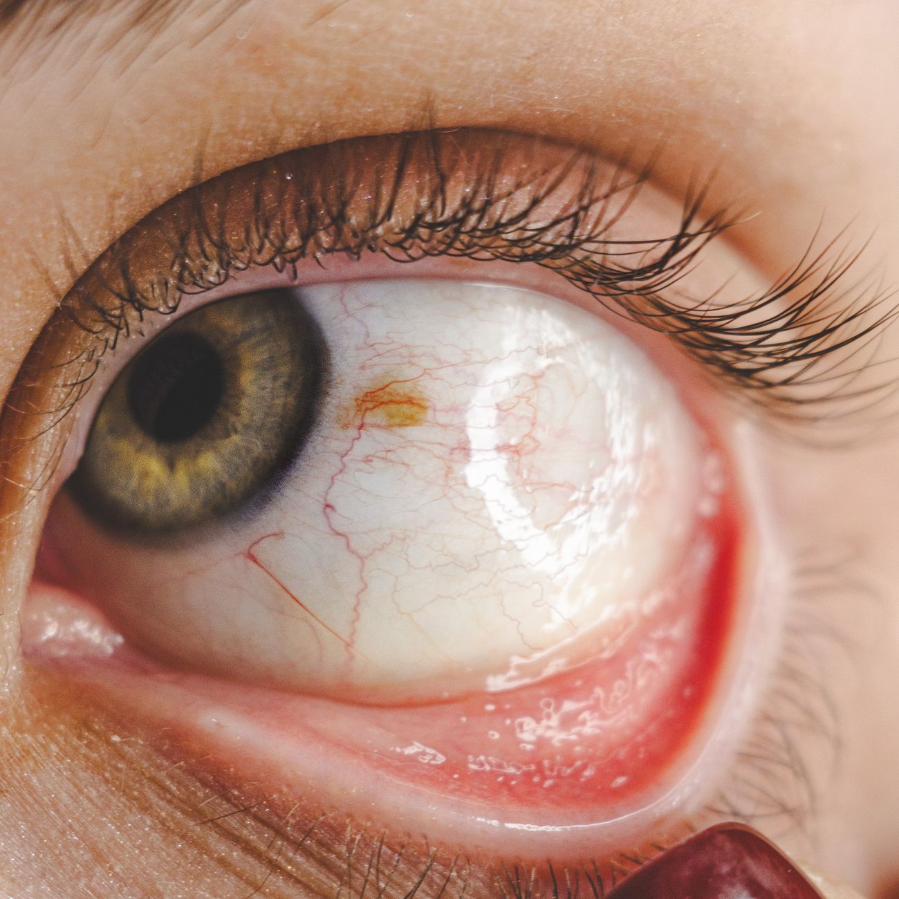 Complications in Vascular Care